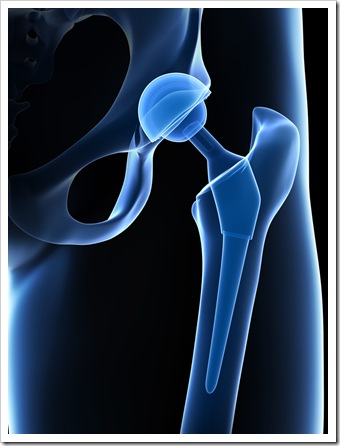 Back Pain Mauldin SC Joint Replacement