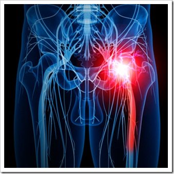 Leg Pain Mauldin SC Sciatica