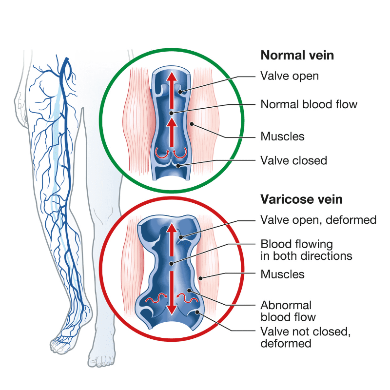 new-varicose-veins-diagram